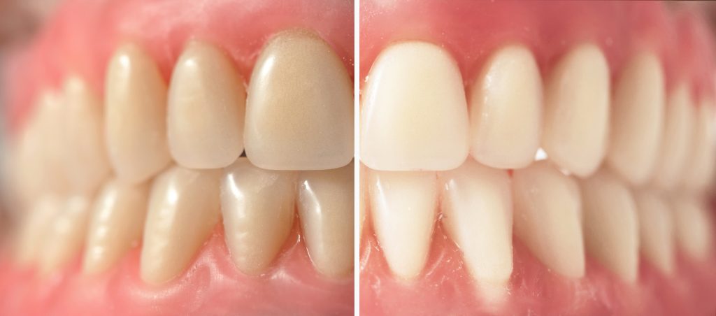 before & after picture of a teeth whitening